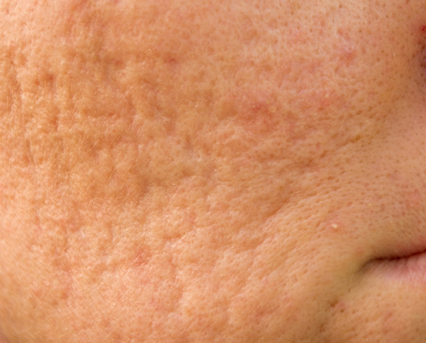 Trị Sẹo Rỗ Sẹo Lõm Bằng Laser Tại Sen Beauty